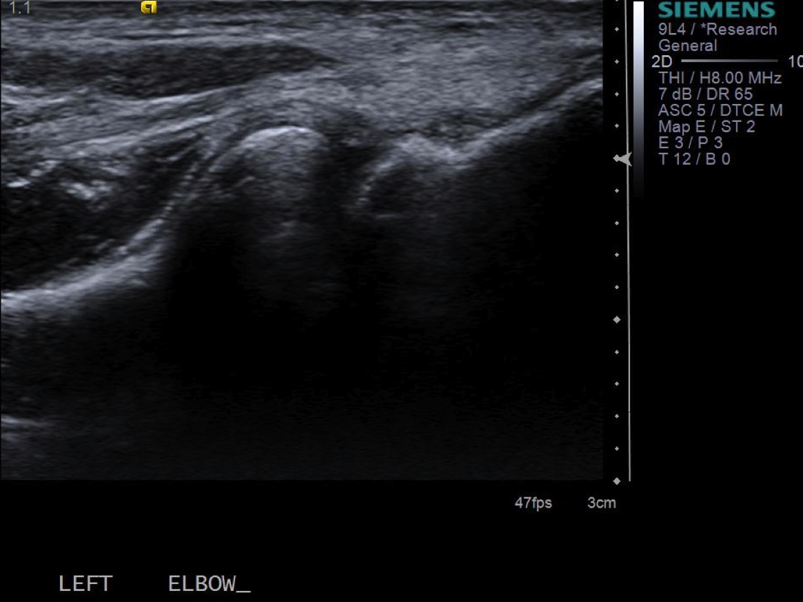 Posterior radiocapitellar recess